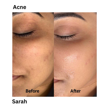 I had a lot of acne before, but after using this product, my skin started to get better. The pimples are smaller now, and my face looks cleaner. I feel more confident and happy with my skin.